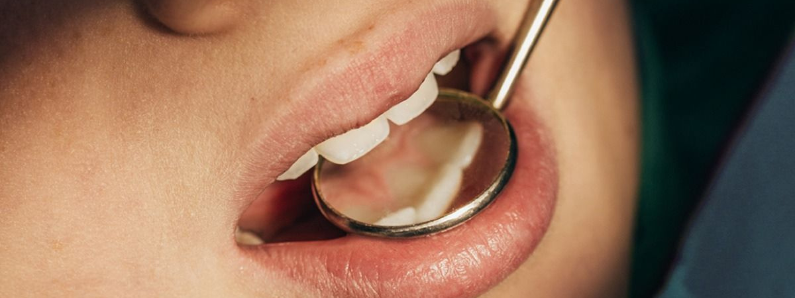 Caring for Dental Implants: Biofilm Control for Long-Term Success