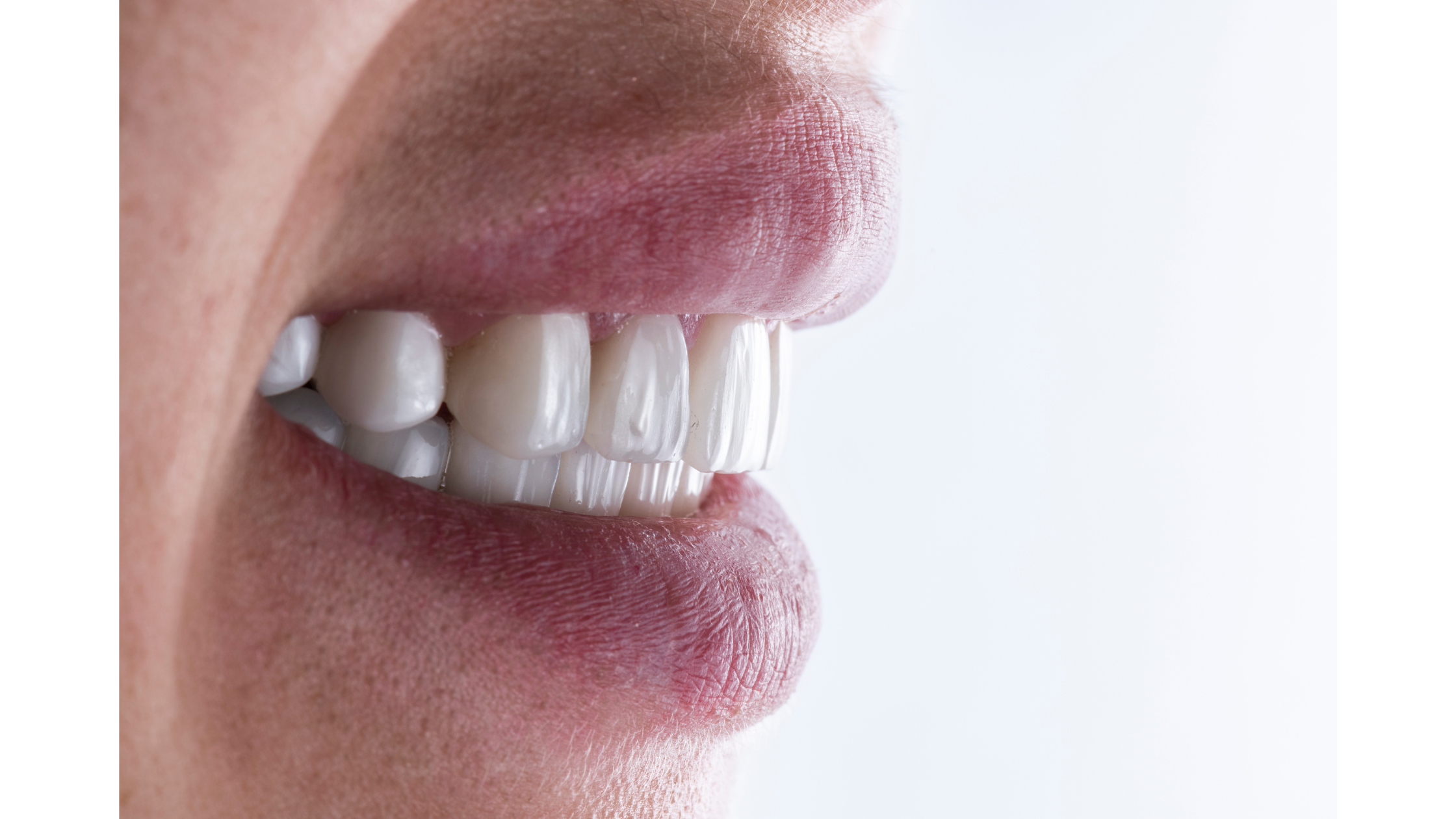 Protect Your Smile: The Best Daily Toothpaste for Veneers, Crowns, and Dental Bonding