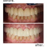 PRAEVA Perio-Implant and Restorative Pro Care System